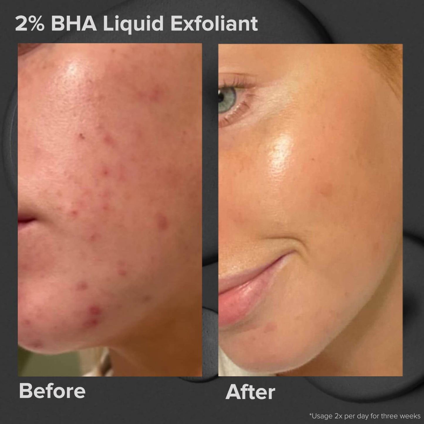 Paula’s Choice 2% BHA Liquid Exfoliant